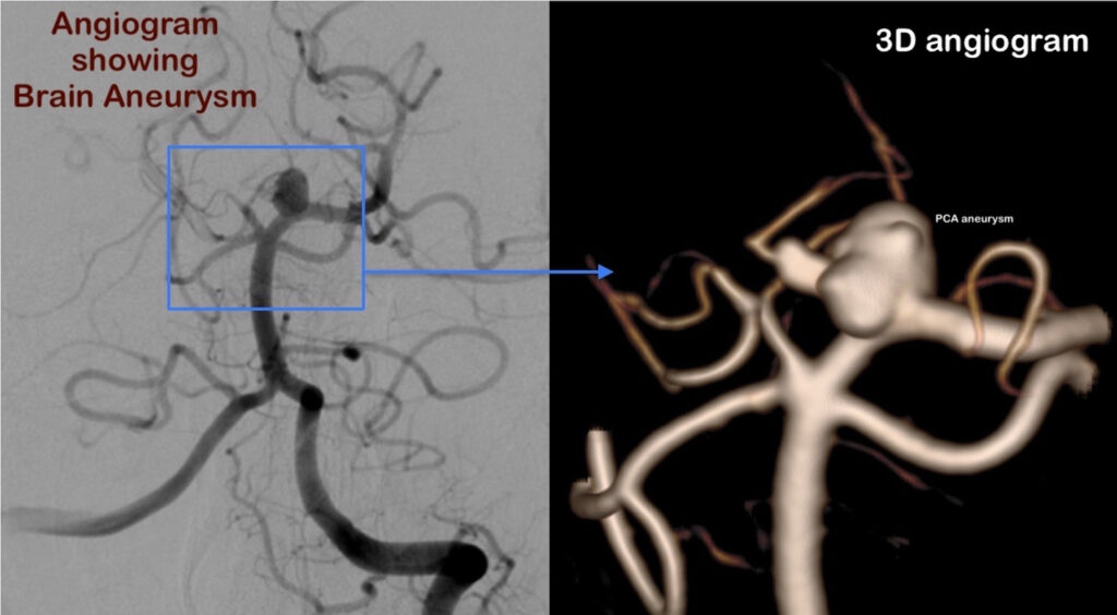 Brain aneurysm treatment in Coimbatore - Coiling & Flow diverter