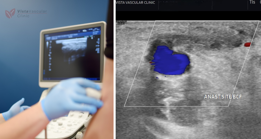 USG showed completely occluded fistula