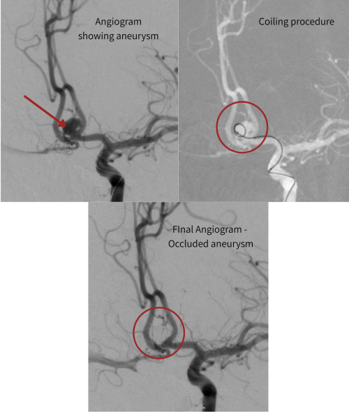 View 2 - Brain Aneurysm coiling